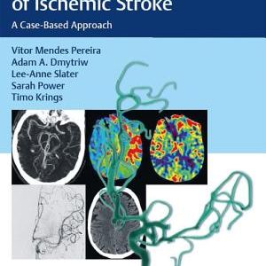 Endovascular Management of Ischemic Stroke: A Case-Based Approach – PDF ebook