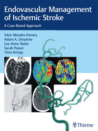 Endovascular Management of Ischemic Stroke: A Case-based Approach – PDF ebook